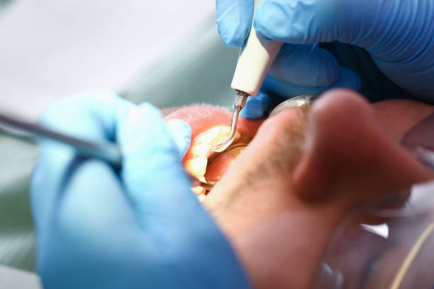 Best Emergency Dental Extractions in Palmetto, GA