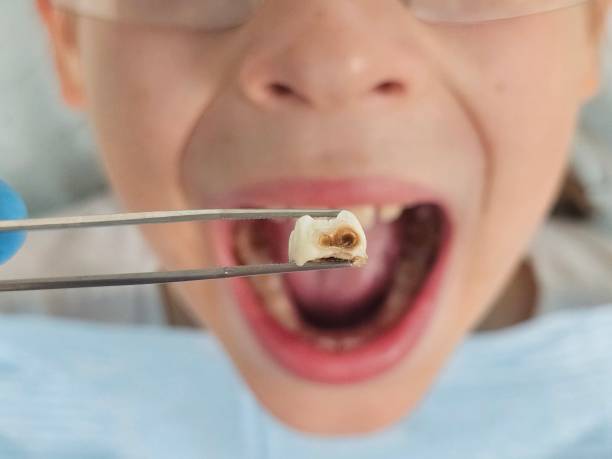 Best Broken or Cracked Tooth Emergency Dentist in Palmetto, GA
